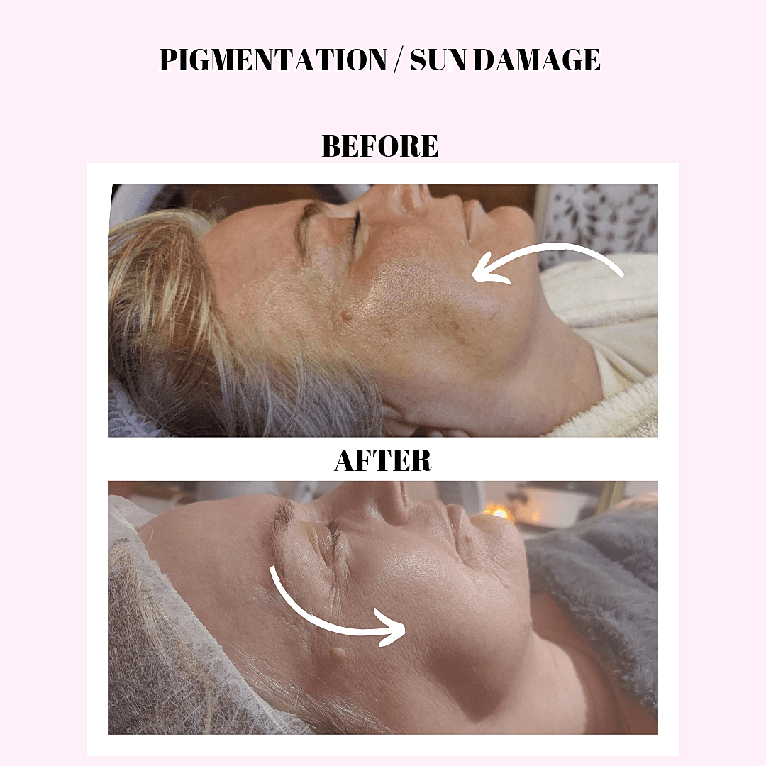 Pigmentation and Sun Damage Before and After Microneedling at The Beauty Barn