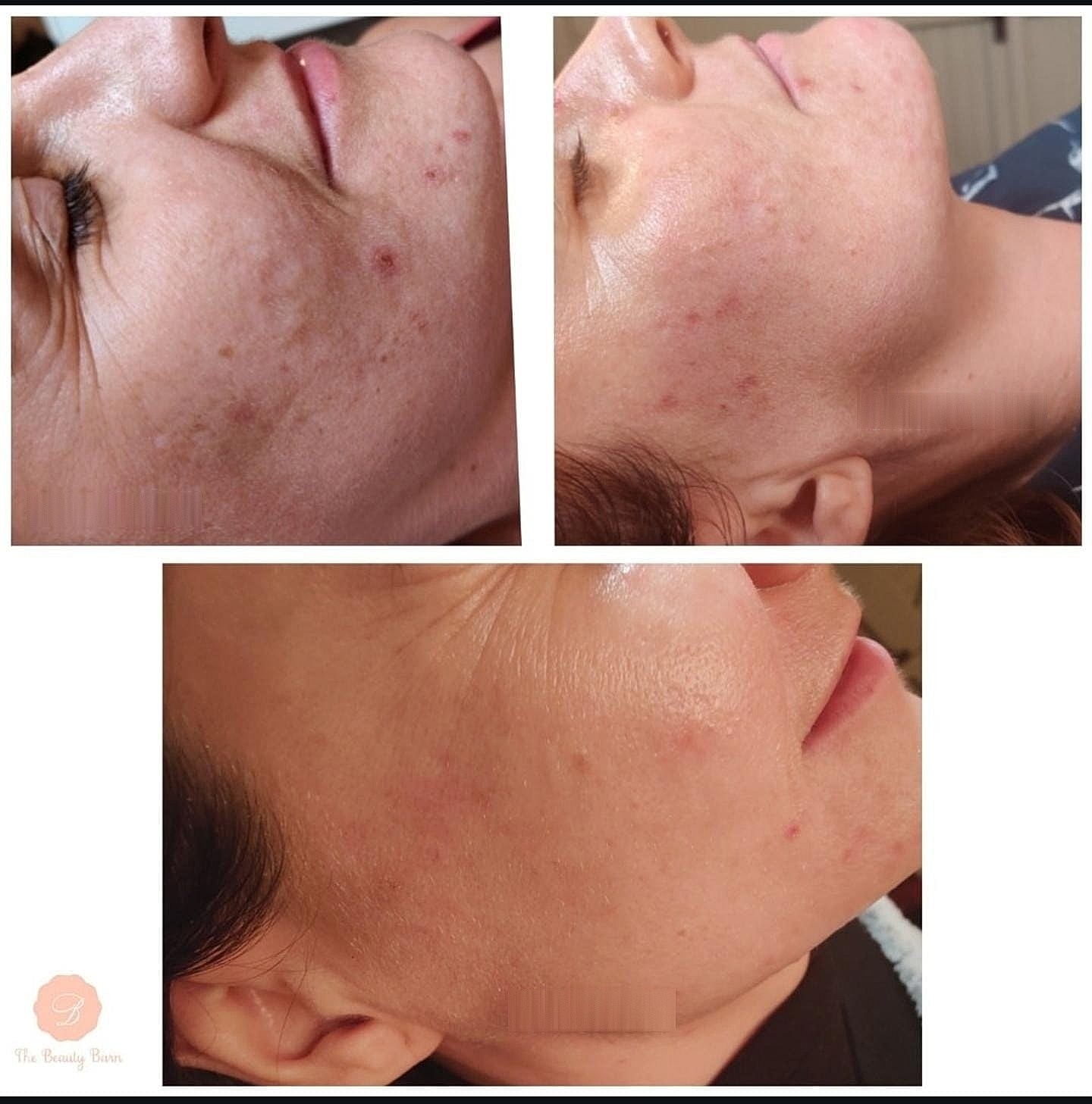 Example of Facial Peels for Active Acne at The Beauty Barn Leicester