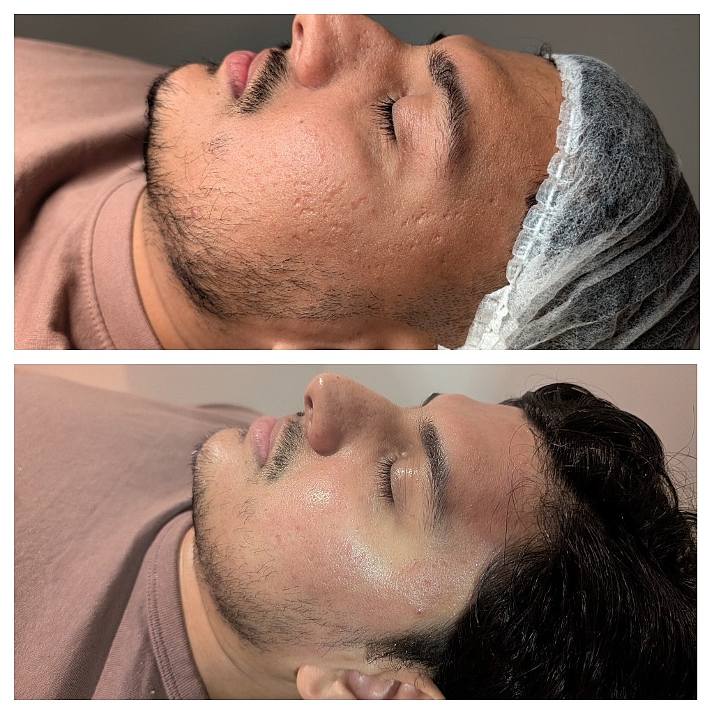 Bespoke Facial Before and After at The Beauty Barn Leicester